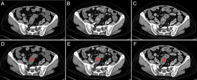 Predicting Kirsten Rat Sarcoma Virus Gene Mutation Status in Patients With Colorectal Cancer by Radiomics Models Based on Multiphasic CT